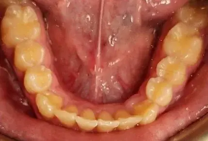 Crowded Teeth treated with clear aligners after orthodontic treatment at Elate Orthodontics, case 3524