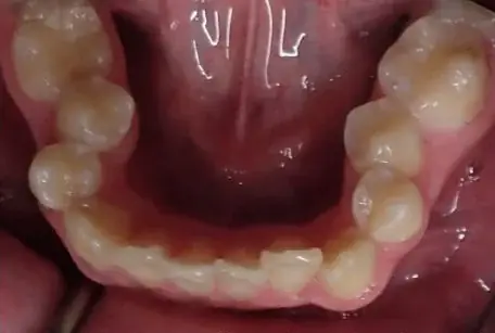 Crowded Teeth treated with clear aligners before orthodontic treatment at Elate Orthodontics, case 3524