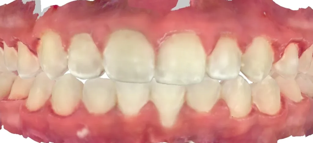 Crowded Teeth after orthodontic treatment at Elate Orthodontics, case 3594