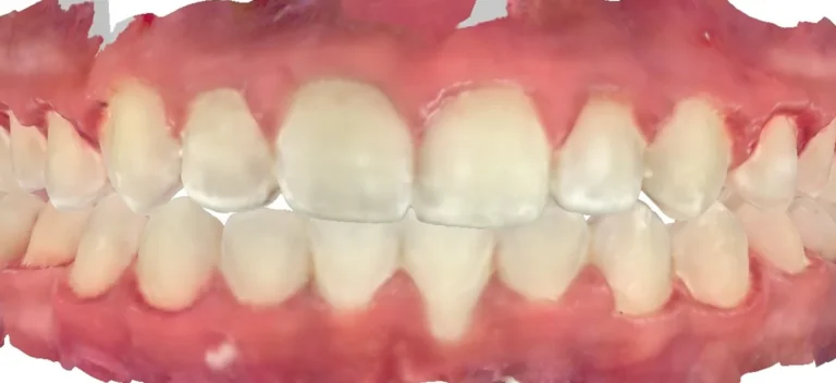 Crowded Teeth after orthodontic treatment at Elate Orthodontics, case 3594