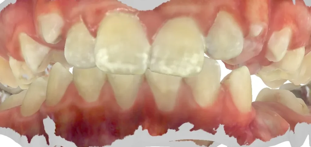 Crowded Teeth before orthodontic treatment at Elate Orthodontics, case 3594