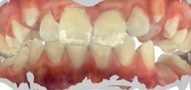 Crowded Teeth before orthodontic treatment at Elate Orthodontics, case 3594
