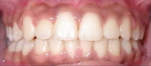 Crowded Teeth treated with braces and expander after orthodontic treatment at Elate Orthodontics, case 3620