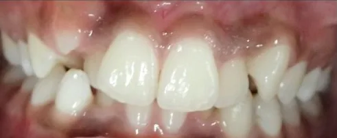 Crowded Teeth treated with braces and expander before orthodontic treatment at Elate Orthodontics, case 3620