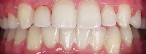 Crowded Teeth treated with braces after orthodontic treatment at Elate Orthodontics, case 3636