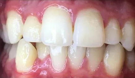 Crowded Teeth treated with braces before orthodontic treatment at Elate Orthodontics, case 3636