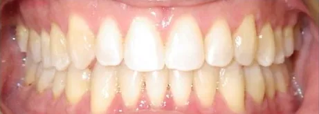 Crowded Teeth treated with clear aligners after orthodontic treatment at Elate Orthodontics, case 3690