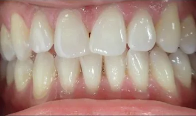 Crowded Teeth treated with clear aligners before orthodontic treatment at Elate Orthodontics, case 3690