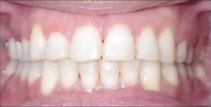 Crowded Teeth treated with clear aligners and braces after orthodontic treatment at Elate Orthodontics, case 3694