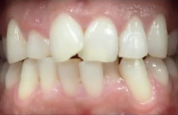 Crowded Teeth treated with clear aligners and braces before orthodontic treatment at Elate Orthodontics, case 3694
