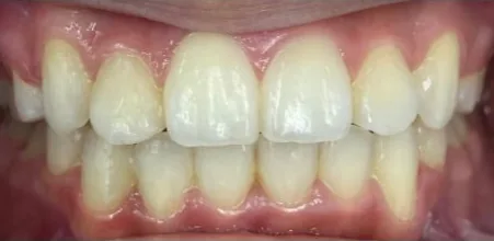 Crowded Teeth treated with braces after orthodontic treatment at Elate Orthodontics, case 3732