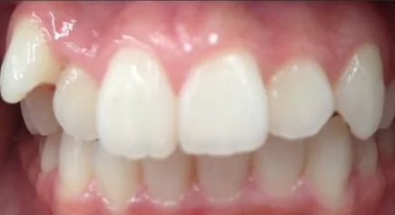 Crowded Teeth treated with braces before orthodontic treatment at Elate Orthodontics, case 3732