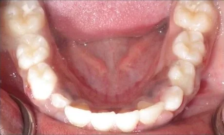 Crowded Teeth treated with braces and early treatment (phase i) after orthodontic treatment at Elate Orthodontics, case 3764