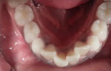 Crowded Teeth treated with braces and early treatment (phase i) before orthodontic treatment at Elate Orthodontics, case 3764