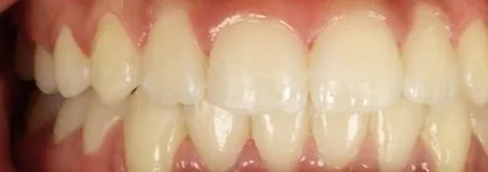 Crowded Teeth treated with clear aligners after orthodontic treatment at Elate Orthodontics, case 3768