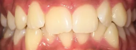 Crowded Teeth treated with clear aligners before orthodontic treatment at Elate Orthodontics, case 3768