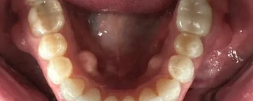 Crowded Teeth treated with clear aligners after orthodontic treatment at Elate Orthodontics, case 3952