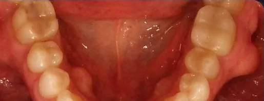 Crowded Teeth treated with clear aligners before orthodontic treatment at Elate Orthodontics, case 3952