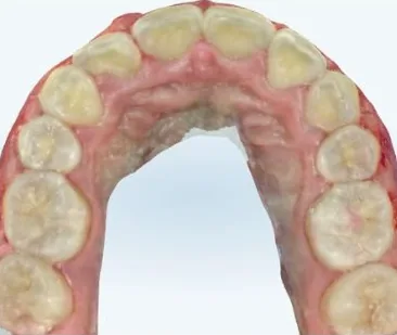 Crowded Teeth treated with braces after orthodontic treatment at Elate Orthodontics, case 3972