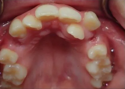 Crowded Teeth treated with braces before orthodontic treatment at Elate Orthodontics, case 3972