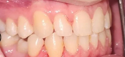 Crowded Teeth and Crossbite treated with braces after orthodontic treatment at Elate Orthodontics, case 3558