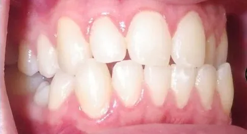 Crowded Teeth and Crossbite treated with braces before orthodontic treatment at Elate Orthodontics, case 3558
