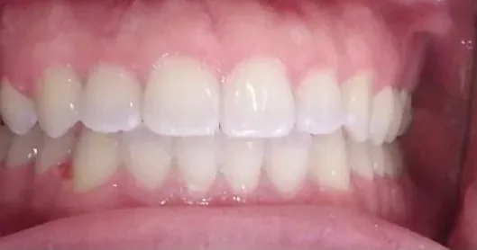 Crowded Teeth and Crossbite treated with clear aligners after orthodontic treatment at Elate Orthodontics, case 3702