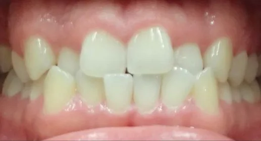 Crowded Teeth and Crossbite treated with clear aligners before orthodontic treatment at Elate Orthodontics, case 3702
