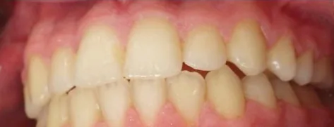 Crowded Teeth and Crossbite treated with braces after orthodontic treatment at Elate Orthodontics, case 3748