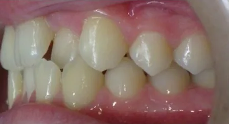Crowded Teeth and Crossbite treated with braces before orthodontic treatment at Elate Orthodontics, case 3748