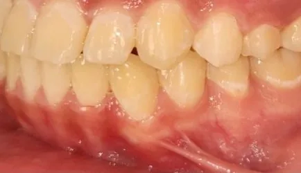 Crowded Teeth, Crossbite and Overbite treated with braces after orthodontic treatment at Elate Orthodontics, case 3976