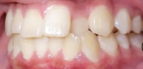 Crowded Teeth, Crossbite and Overbite treated with braces before orthodontic treatment at Elate Orthodontics, case 3976