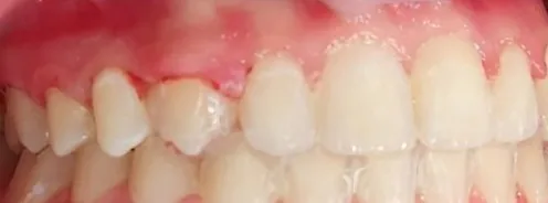 Crowded Teeth, Crossbite and Overbite treated with braces after orthodontic treatment at Elate Orthodontics, case 4042