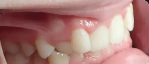 Crowded Teeth, Crossbite and Overbite treated with braces before orthodontic treatment at Elate Orthodontics, case 4042