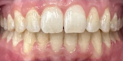 Crowded Teeth and Edge-to-Edge Bite treated with clear aligners after orthodontic treatment at Elate Orthodontics, case 3916