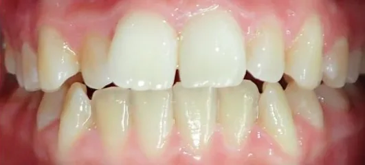 Crowded Teeth and Edge-to-Edge Bite treated with clear aligners before orthodontic treatment at Elate Orthodontics, case 3916