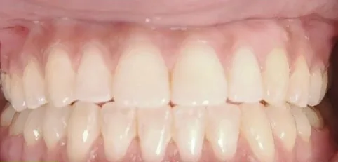 Crowded Teeth and Edge-to-Edge Bite treated with braces after orthodontic treatment at Elate Orthodontics, case 3994