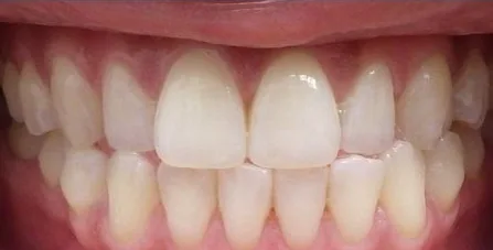 Crowded Teeth and Edge-to-Edge Bite treated with braces before orthodontic treatment at Elate Orthodontics, case 3994