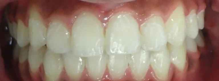 Crowded Teeth and Impacted Teeth treated with braces after orthodontic treatment at Elate Orthodontics, case 3508