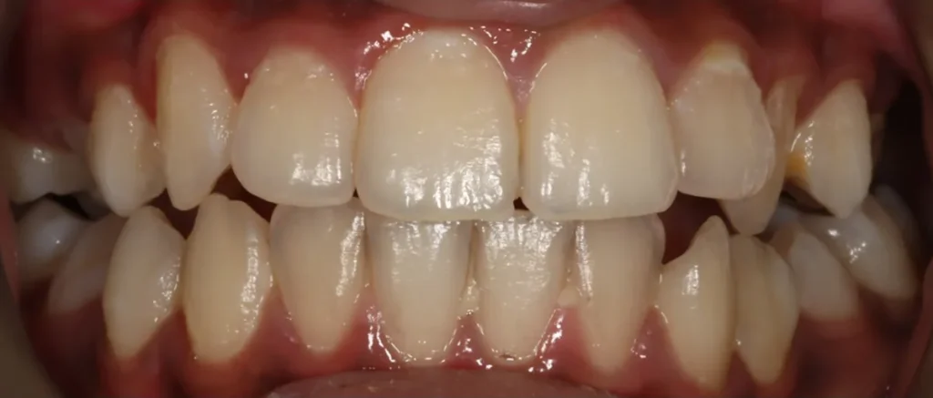 Crowded Teeth and Impacted Teeth treated with braces before orthodontic treatment at Elate Orthodontics, case 3508