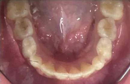 Crowded Teeth and Narrow Palate treated with braces, expander and early treatment (phase i) after orthodontic treatment at Elate Orthodontics, case 3656