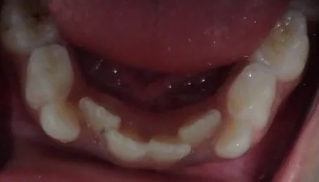 Crowded Teeth and Narrow Palate treated with braces, expander and early treatment (phase i) before orthodontic treatment at Elate Orthodontics, case 3656
