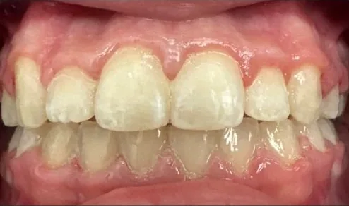 Crowded Teeth and Narrow Palate treated with braces and expander after orthodontic treatment at Elate Orthodontics, case 3678
