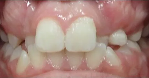 Crowded Teeth and Narrow Palate treated with braces and expander before orthodontic treatment at Elate Orthodontics, case 3678