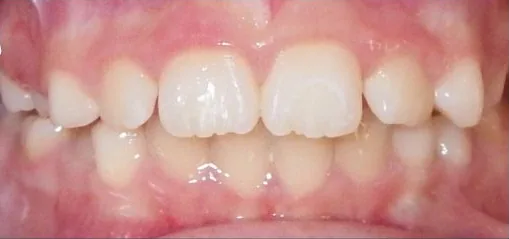 Crowded Teeth and Narrow Palate treated with clear aligners and early treatment (phase i) after orthodontic treatment at Elate Orthodontics, case 3706