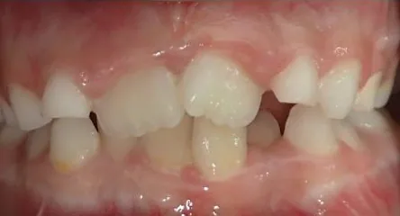 Crowded Teeth and Narrow Palate treated with clear aligners and early treatment (phase i) before orthodontic treatment at Elate Orthodontics, case 3706