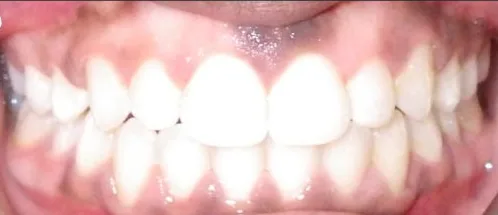 Crowded Teeth and Narrow Palate treated with clear aligners after orthodontic treatment at Elate Orthodontics, case 3740
