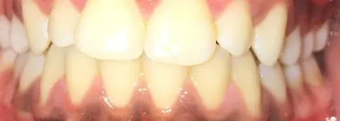 Crowded Teeth and Narrow Palate treated with clear aligners before orthodontic treatment at Elate Orthodontics, case 3740