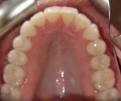 Crowded Teeth and Narrow Palate treated with clear aligners after orthodontic treatment at Elate Orthodontics, case 3792