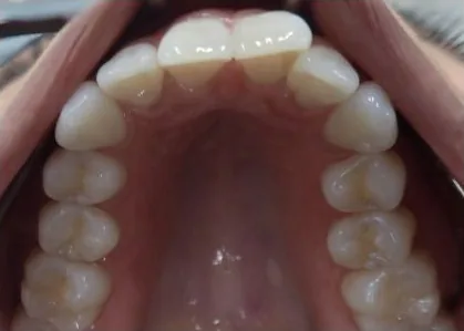 Crowded Teeth and Narrow Palate treated with clear aligners before orthodontic treatment at Elate Orthodontics, case 3792